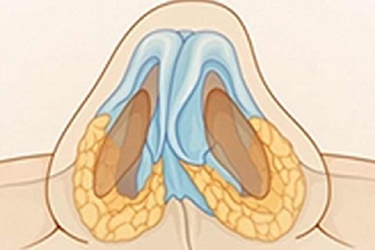 chirurgie septum