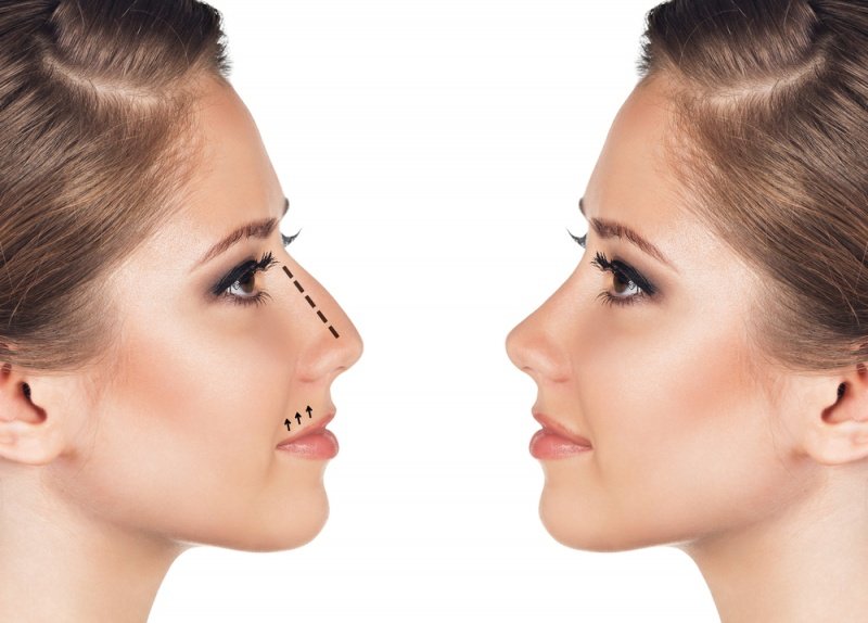 rhinoplastie-prix