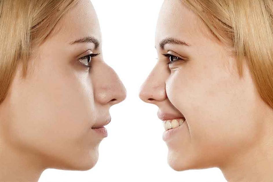 rhinoplastie-tunisie